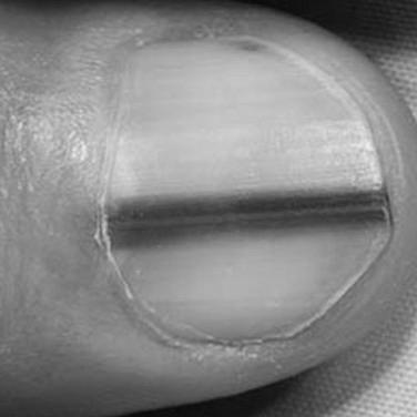 How does our finger nail indicate our health conditions? photo 15