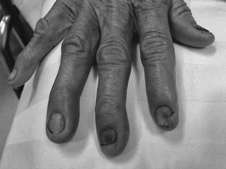 How does our finger nail indicate our health conditions? photo 0