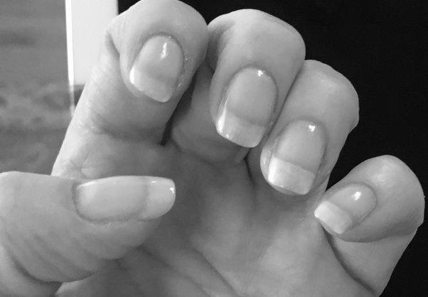 How do you heal short nail beds after years of nail biting? image 3