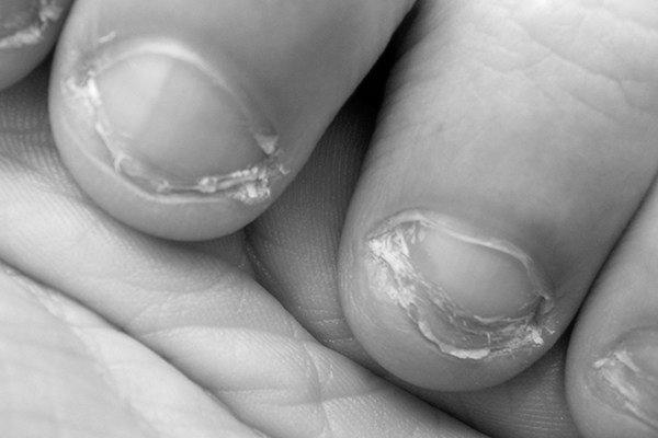 How do you heal short nail beds after years of nail biting? image 10