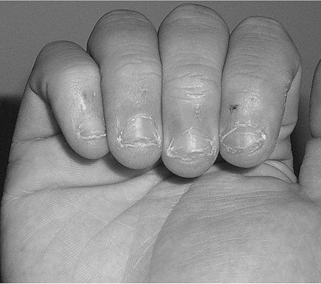 How do you heal short nail beds after years of nail biting? image 11