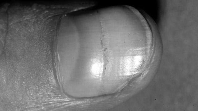 How do you remove black lines in the finger nails? image 3