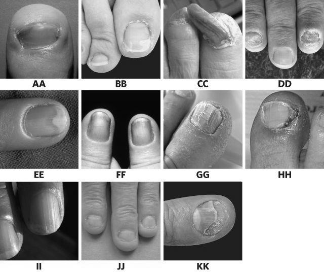 Why should we study nail disorders and diseases? photo 7