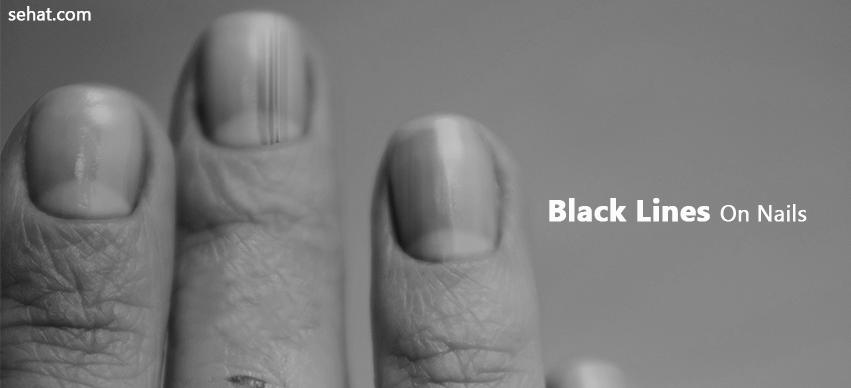 What causes black lines in nails? How can you treat it? image 0