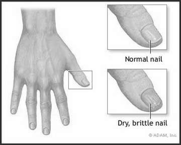 How to take care of brittle nails? image 10