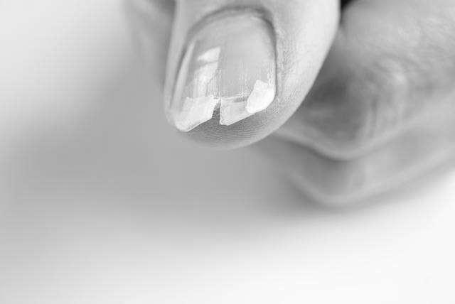 What causes brittle nails and what is its quick remedy? image 1