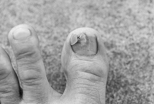 How long does it take for a big toe nail take to grow completely? image 1