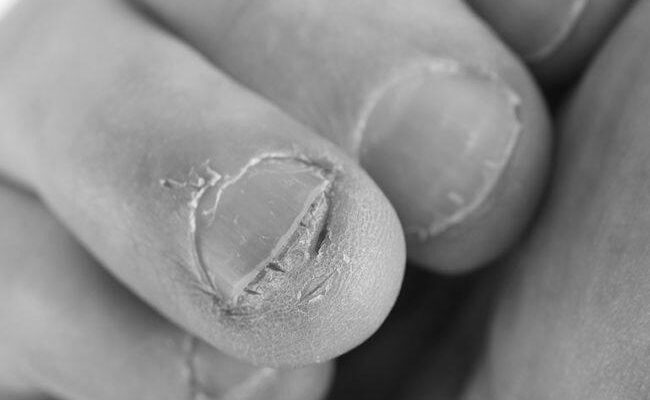 Does nail biting cause serious problems? What are they? photo 0