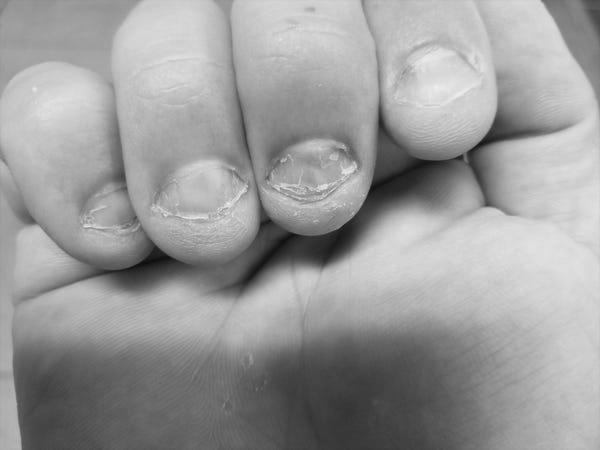 Does nail biting cause serious problems? What are they? photo 6