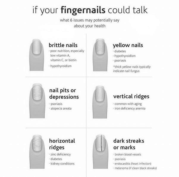 What can fingernails say about your health? image 8