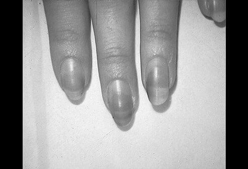 What causes someone to have orange fingernails? image 1