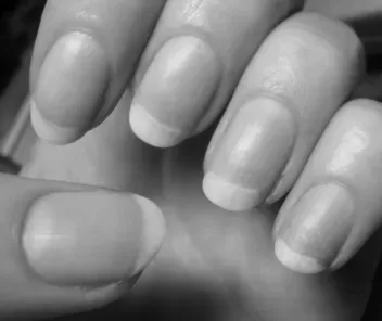 What causes someone to have orange fingernails? image 6