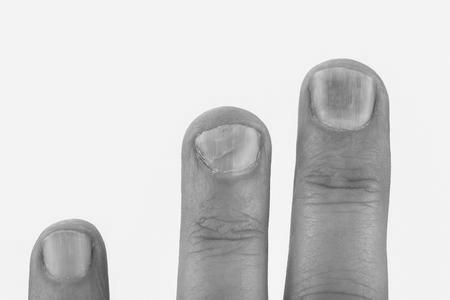 What causes someone to have orange fingernails? image 8