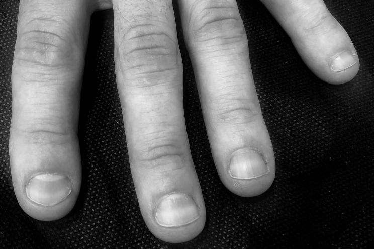 What causes someone to have orange fingernails? image 10