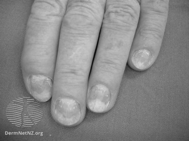 What causes my nails to turn white? photo 10
