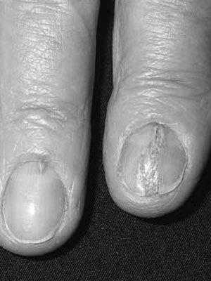 What do split fingernails indicate? image 6