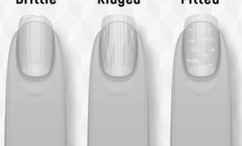 What can fingernails say about your health? image 1