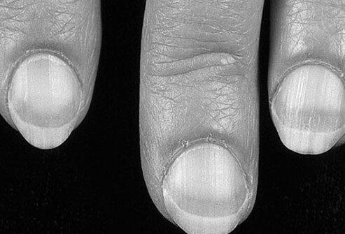 What can fingernails say about your health? photo 1