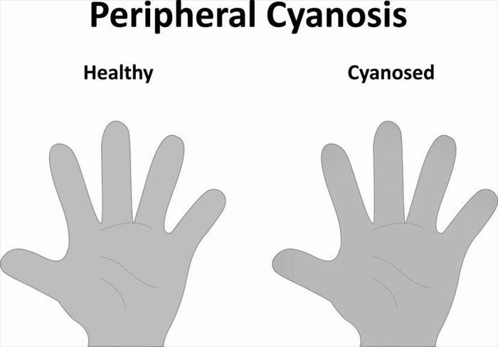 What causes purple fingernails? photo 4