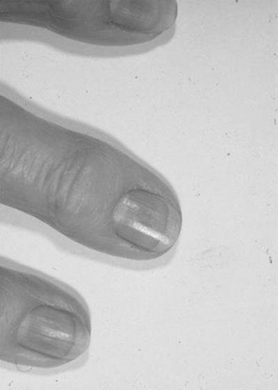 What causes purple fingernails? photo 7