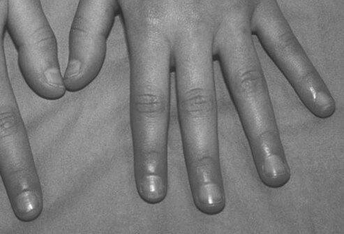 What causes purple fingernails? photo 11