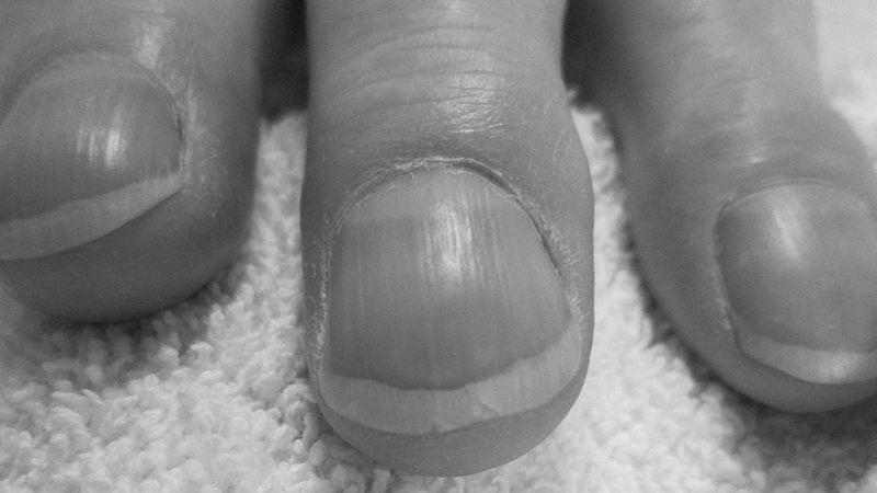 Is nails condition shows tells about our health? image 9