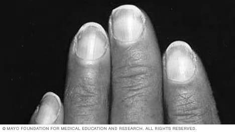 Is nails condition shows tells about our health? image 14