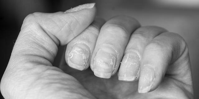 What is scaly and peeling nails a sign of? photo 2