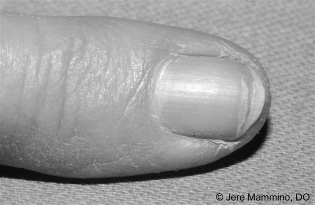 What is scaly and peeling nails a sign of? photo 3