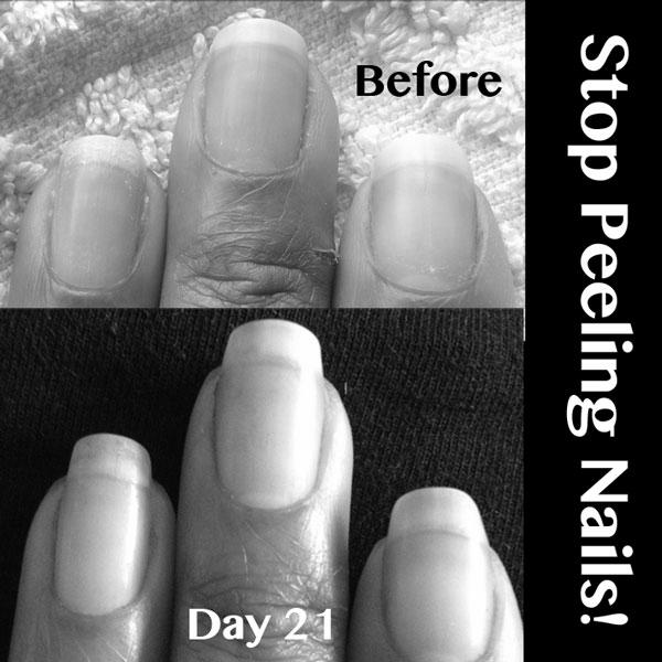 What is scaly and peeling nails a sign of? photo 5