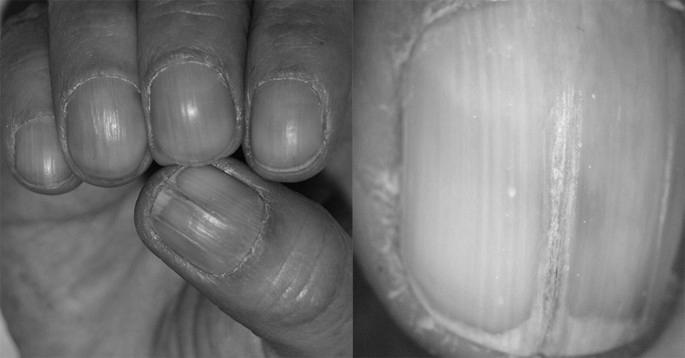 Why do natural nails split down the middle? image 10