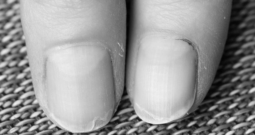 How do I prevent my nails from cracking? image 5