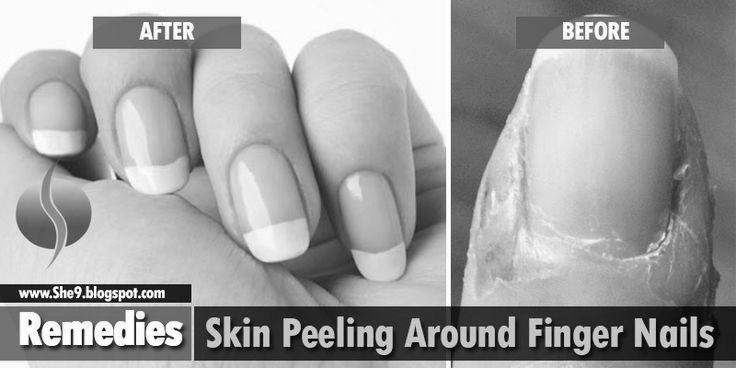 Peeling skin below finger nails What could be the problem? image 10