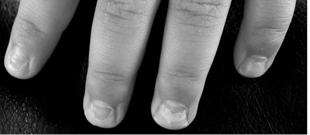 Why is my nail peeling from its base? image 1
