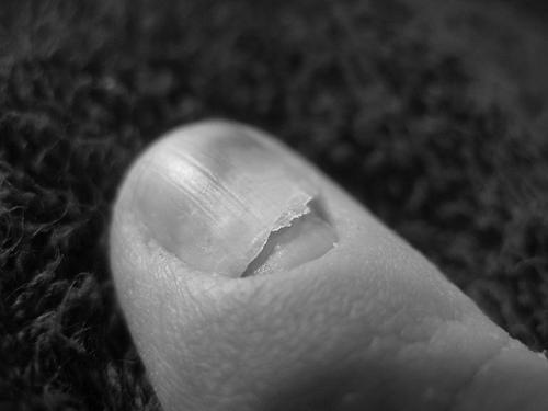 Why is my nail peeling from its base? image 5