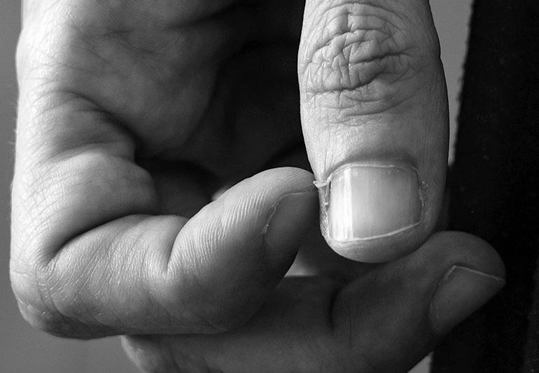 How do I get rid of skin tearing near finger nails? photo 4