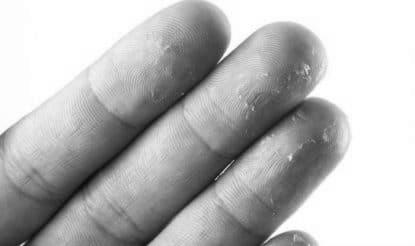 How do I get rid of skin tearing near finger nails? photo 6