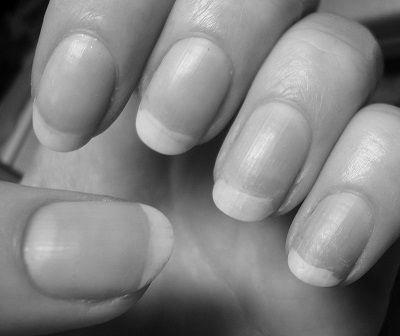 What are some treatments for yellow fingernails? image 0