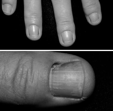 What are some treatments for yellow fingernails? image 1