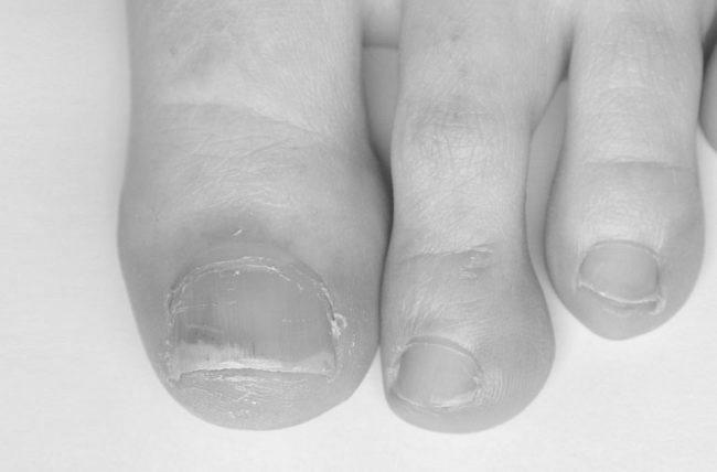 What are some treatments for yellow fingernails? image 6