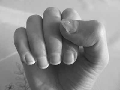 What are some treatments for yellow fingernails? image 12