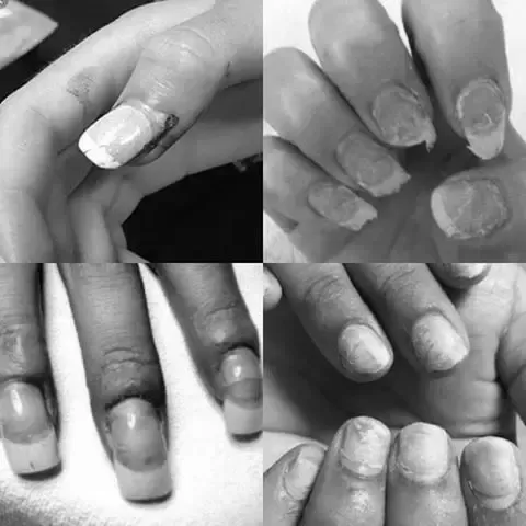 Do acrylic nails ruin your real nails for years? photo 2