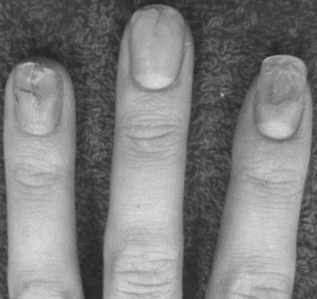Do acrylic nails ruin your real nails for years? photo 6
