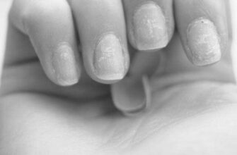 What is the cause and cure for brittle nails? image 0