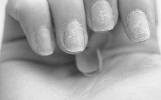 What is the cause and cure for brittle nails? image 0
