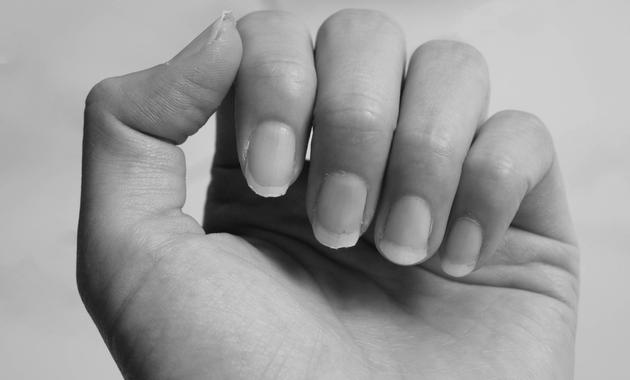 What is the cause and cure for brittle nails? image 3