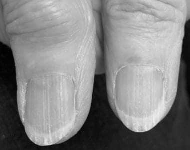 What is the cause and cure for brittle nails? image 7