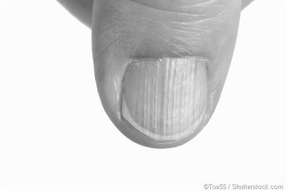 What is the cause and cure for brittle nails? image 8