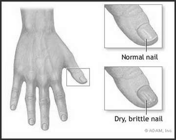 How to take care of brittle nails? photo 7