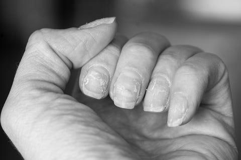 What is scaly and peeling nails a sign of? photo 2